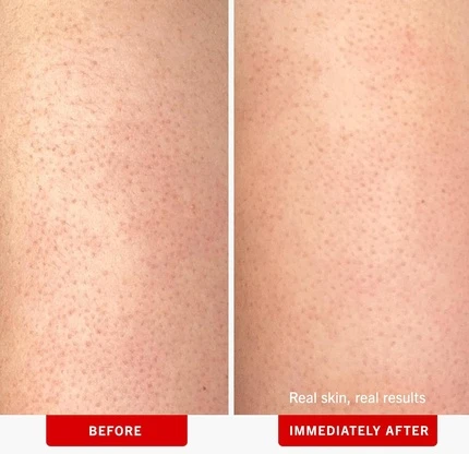 Скраб для тела First Aid Beauty First Aid Beauty KP Bump Eraser Body Scrub с 10% AHA
